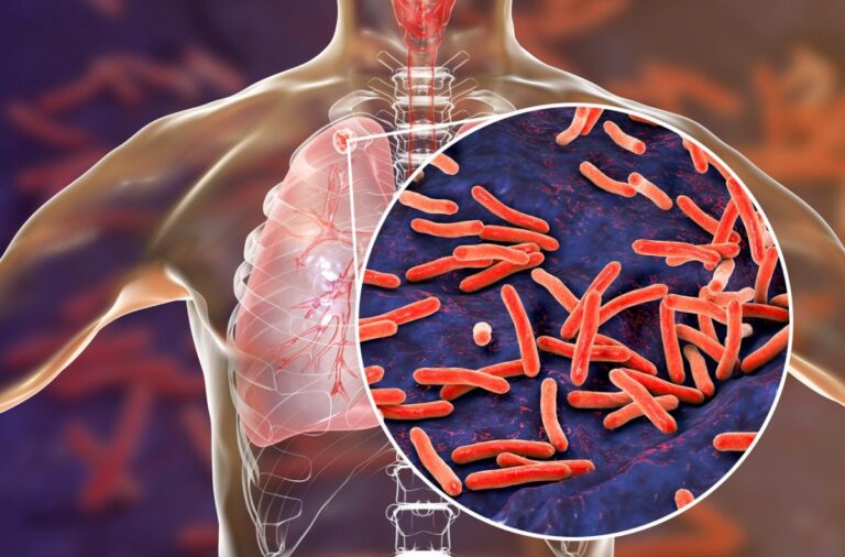 Tuberculosis en Salta | Los números provinciales siguen siendo los más altos del país
